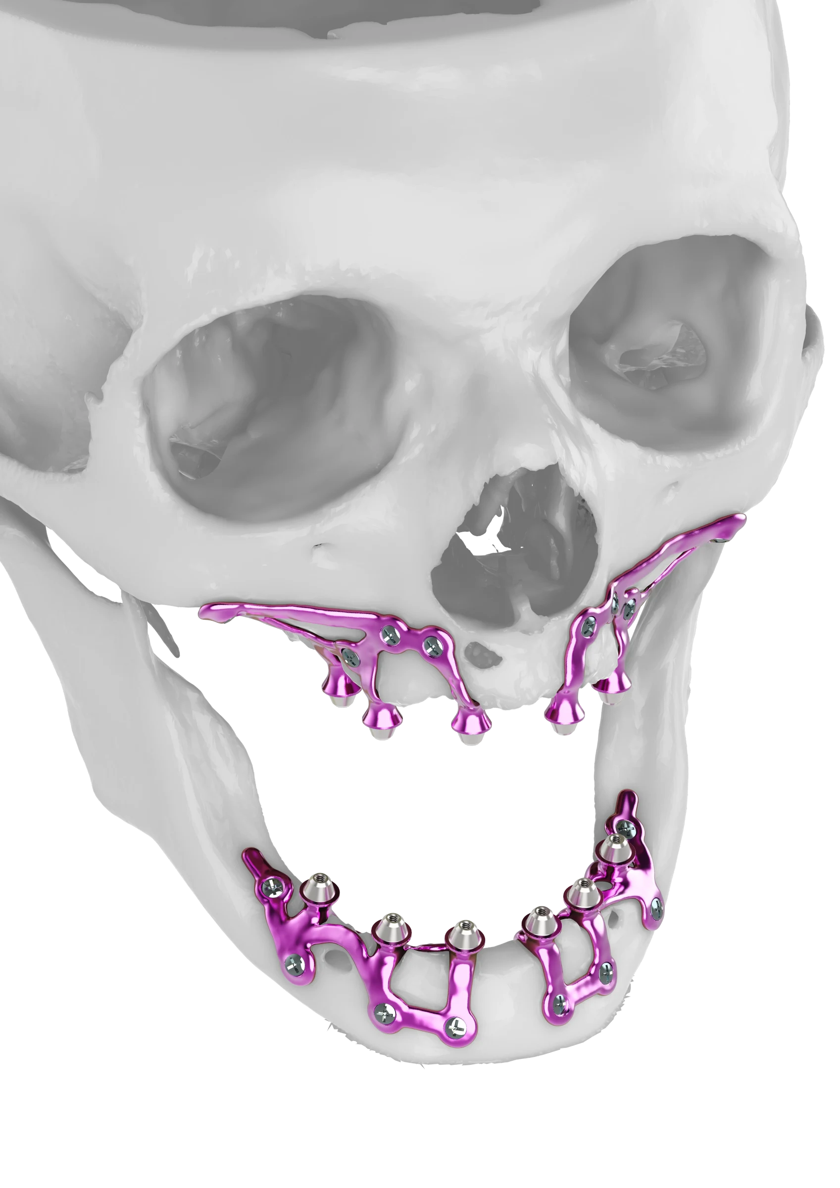 Full arch implant bars for an IUXTA-3D restoration